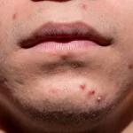 How to get rid of acne fast