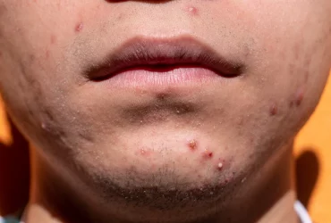 How to get rid of acne fast