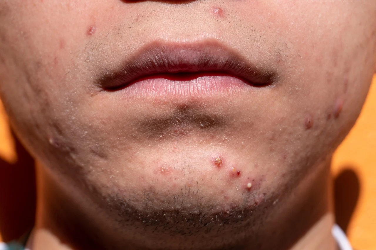 You are currently viewing মাত্র ৩ দিনে ব্রণ থেকে চিরতরে মুক্তি | Remove pimples